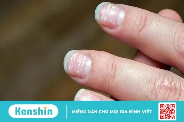 Nhìn móng tay đoán bệnh, bạn đã biết chưa? 5