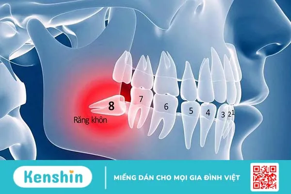 Nhổ 2 răng khôn cùng lúc có nguy hiểm không? 2