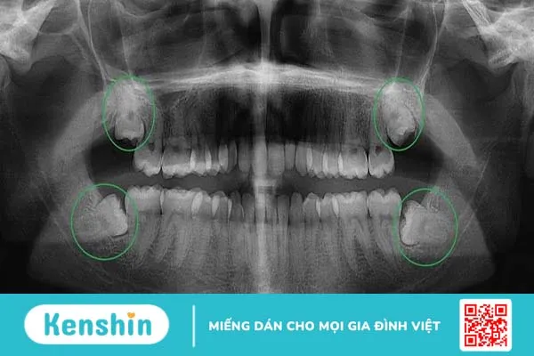 Nhổ 2 răng khôn cùng lúc có nguy hiểm không? 4