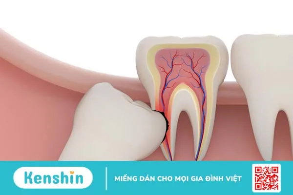 Nhổ răng khôn xong nên làm gì để giảm đau nhức? 1