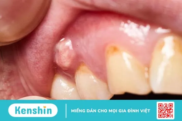 Nhổ răng xong nên ăn gì cho mau lành? 2