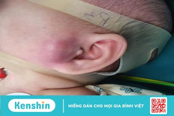 Nhọt ống tai ngoài ở trẻ sơ sinh: Bố mẹ không nên xem thường 1