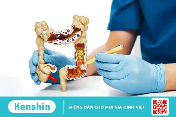 Những bệnh nhân viêm trực tràng uống thuốc gì? 5