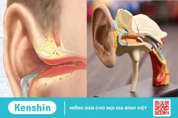 Những biến chứng viêm tai xương chũm có thể bạn chưa biết1