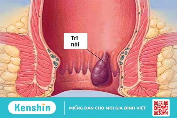 Bệnh trĩ nội là gì? Cách chữa bệnh trĩ nội an toàn và hiệu quả?