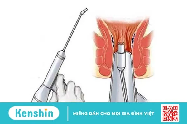 Đốt búi trĩ là phương pháp điều trị bằng tiểu phẫu áp dụng cho búi trĩ có kích thước nhỏ