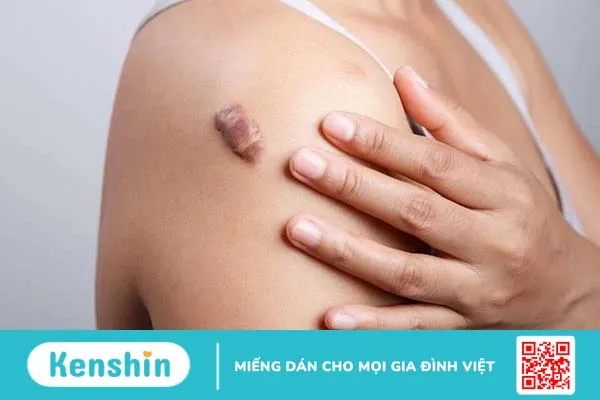 Trị sẹo lồi bằng phương pháp dân gian vừa tiết kiệm, đơn giản mà vẫn mang lại hiệu quả cao