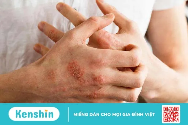 Nguyên nhân gây dị ứng bao cao su: Dị ứng mủ cao su