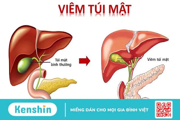 Những cấp độ viêm túi mật cấp tính phổ biến nhất và phương pháp chẩn đoán 1