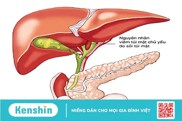 Những cấp độ viêm túi mật cấp tính phổ biến nhất và phương pháp chẩn đoán 4