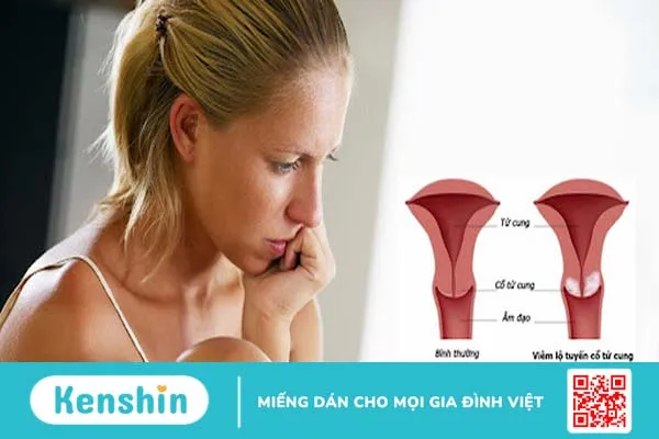 Những Chia Sẻ Về Viêm Lộ Tuyến Tử Cung Độ 3 2