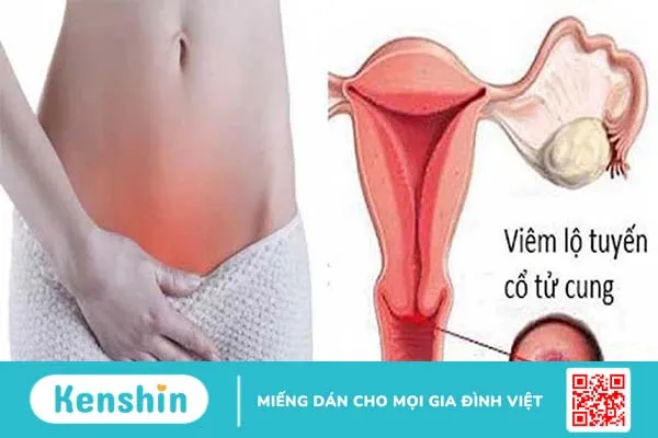 Những Chia Sẻ Về Viêm Lộ Tuyến Tử Cung Độ 3