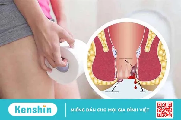 Những điều bạn cần biết về cây lức chữa bệnh trĩ an toàn nhất 4