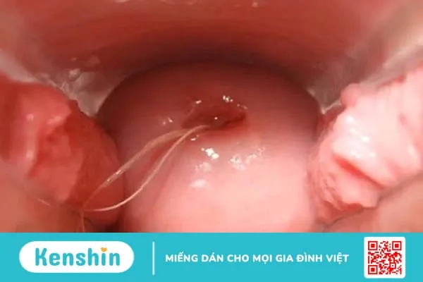 Những điều bạn nên biết về bệnh viêm  lộ tuyến cổ tử cung sau sinh 1