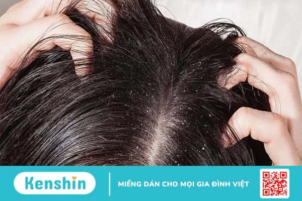 Những điều cần biết khi điều trị nấm tổ ong da đầu