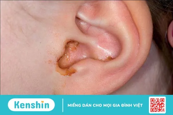 Những điều cần biết về bệnh lý tai chảy mủ 1