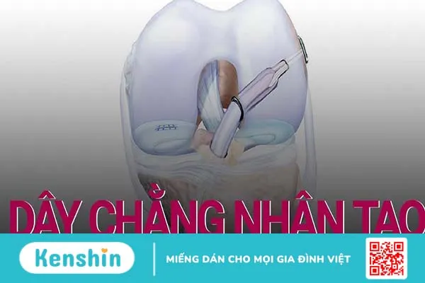 Dây chằng nhân tạo và những điều cần biết 1