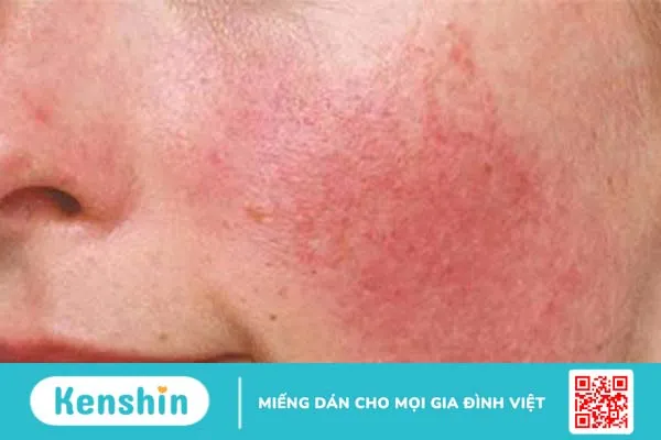 Những điều cần biết về dị ứng mỹ phẩm và cách phòng tránh 1