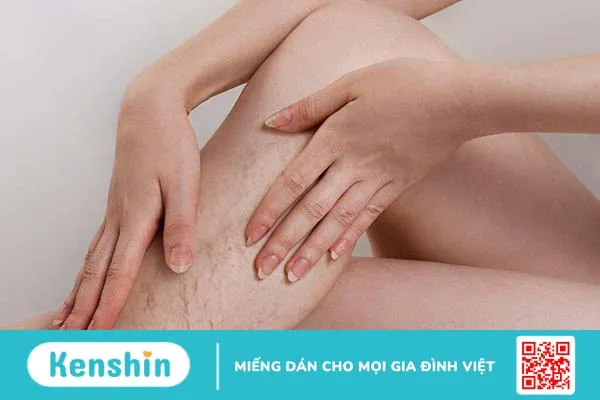 Những điều cần biết về keo sinh học tĩnh mạch và bệnh suy giãn tĩnh mạch chi dưới 1