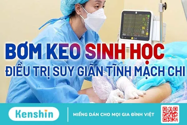 Những điều cần biết về keo sinh học tĩnh mạch và bệnh suy giãn tĩnh mạch chi dưới 2