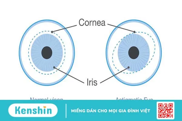 Những điều cần biết về kính loạn thị 1