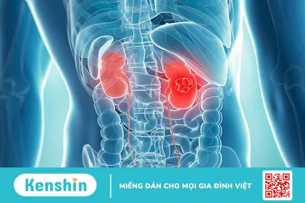 Những điều cần biết về phương pháp phẫu thuật nội soi cắt u thận 1