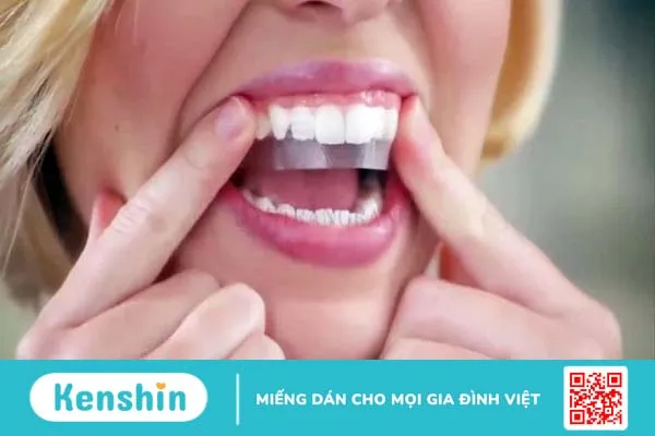 Miếng dán trắng răng mang lại hiệu quả làm trắng rỏ rệt, nhanh chóng