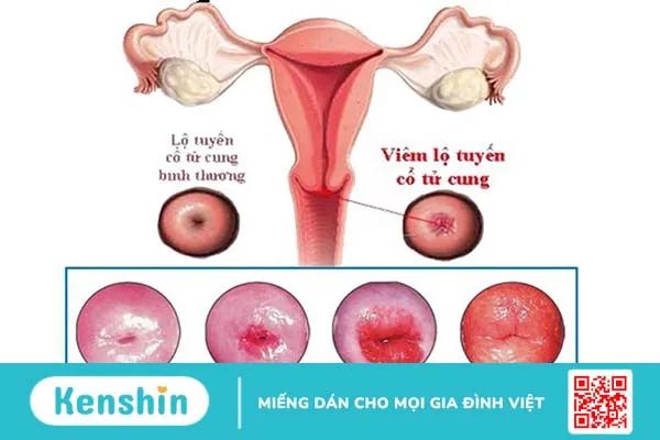 Những kiến thức hữu ích về viêm lộ tuyến cổ tử cung khi đang mang thai 1