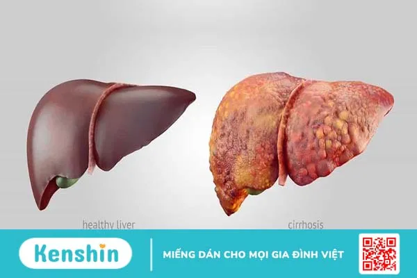 Những nguyên nhân nào khiến chỉ số GGT tăng cao? 1