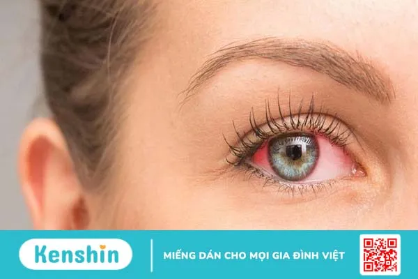 Những tác hại của việc đeo lens3