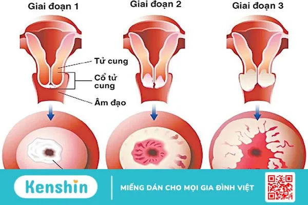 Những thông tin bạn cần biết về tình trạng viêm lộ tuyến tử cung 1cm 1