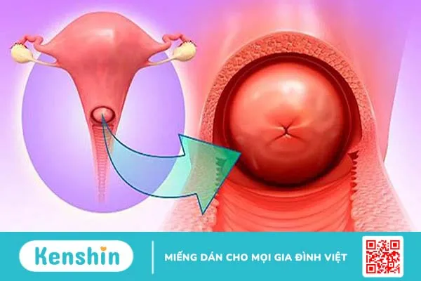 Những thông tin bạn cần biết về tình trạng viêm lộ tuyến tử cung 1cm 3