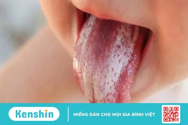 Những thông tin cần biết về căn bệnh nấm miệng dưới lưỡi ở trẻ em1