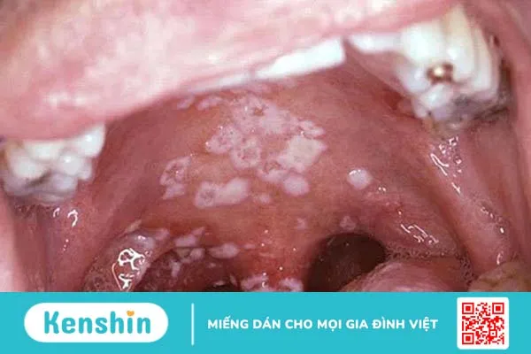 Những thông tin cần biết về nấm họng Candida 1