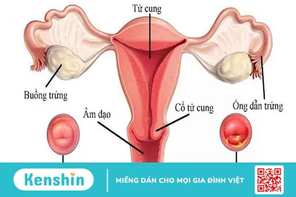 Những thông tin về bệnh viêm lộ tuyến tử cung độ 2 mà bạn cần tham khảo 1