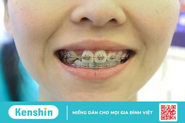 Niềng răng bị lệch mặt: Nguyên nhân, cách khắc phục và cách phòng ngừa 1