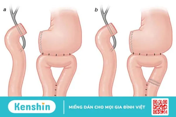 Nối dạ dày hỗng tràng là gì? Phương pháp nối và những lưu ý sau điều trị 1