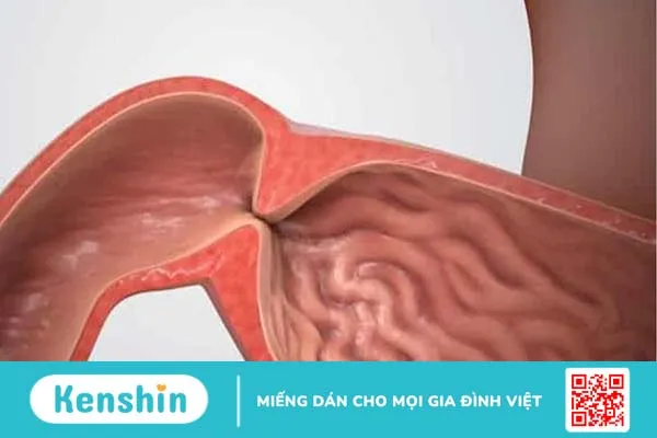 Nối dạ dày hỗng tràng là gì? Phương pháp nối và những lưu ý sau điều trị 2