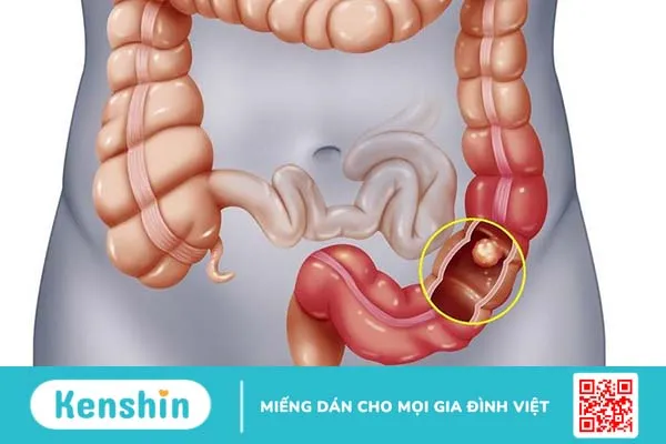 Nổi hạch ở bụng: Nguyên nhân, dấu hiệu nhận biết và biện pháp phòng tránh 2