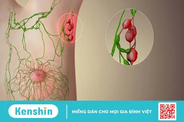 Nổi hạch ở nách có mủ nguy hiểm không? Điều trị hiện tượng nổi hạch ở nách như thế nào? 2