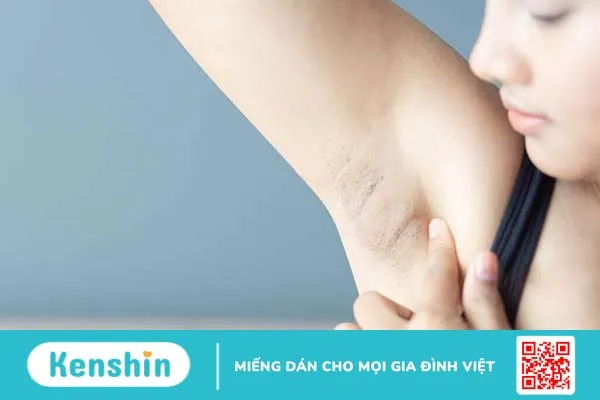 Nổi hạch ở nách phải nữ giới: Đặc điểm, nguyên nhân và cách điều trị 1