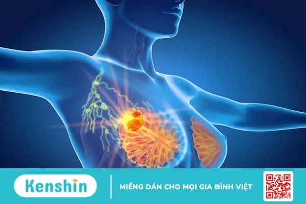 Nổi hạch ở nách phải nữ giới: Đặc điểm, nguyên nhân và cách điều trị 2