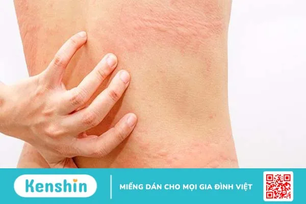 Nổi mề đay cấp tính: Khái niệm, dấu hiệu, nguyên nhân và cách xử trí 2