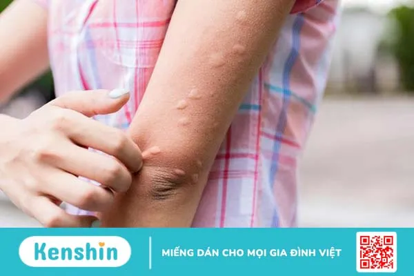 Nổi mề đay cấp tính: Khái niệm, dấu hiệu, nguyên nhân và cách xử trí 3