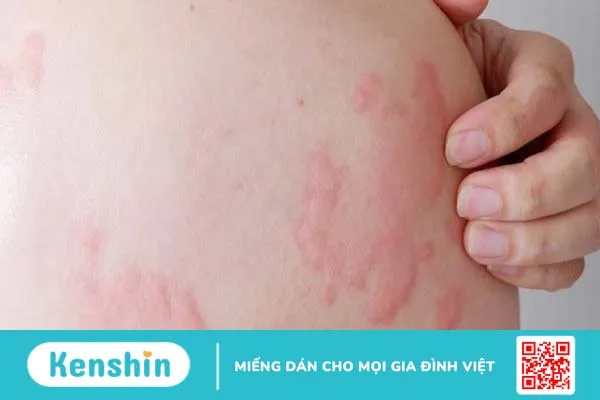 Nổi mề đay cấp tính: Khái niệm, dấu hiệu, nguyên nhân và cách xử trí 1