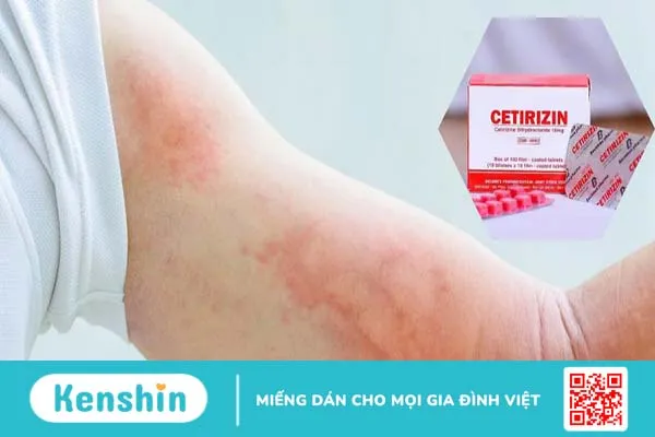 Nổi mề đay cấp tính: Khái niệm, dấu hiệu, nguyên nhân và cách xử trí 4