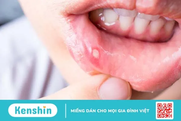 Nổi mụn trắng trong miệng không đau là dấu hiệu bệnh gì 1