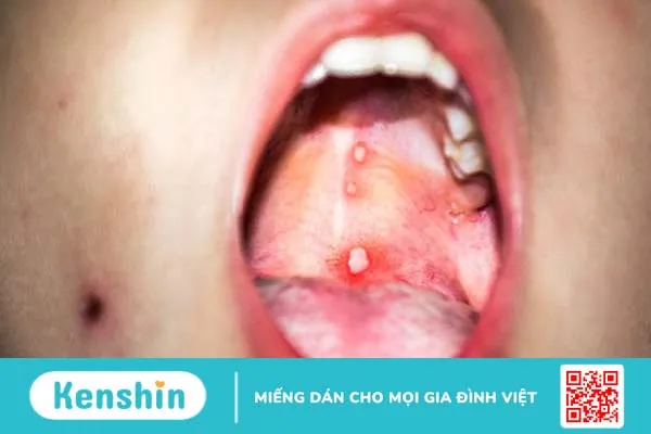 Nổi mụn trắng trong miệng không đau là dấu hiệu bệnh gì 2