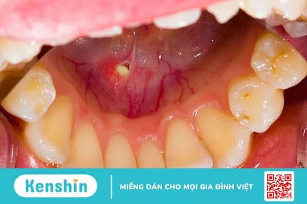 Nổi mụn trắng trong miệng không đau là dấu hiệu bệnh gì 3