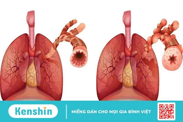 Hen phế quản: Phác đồ điều trị hen phế quản 1